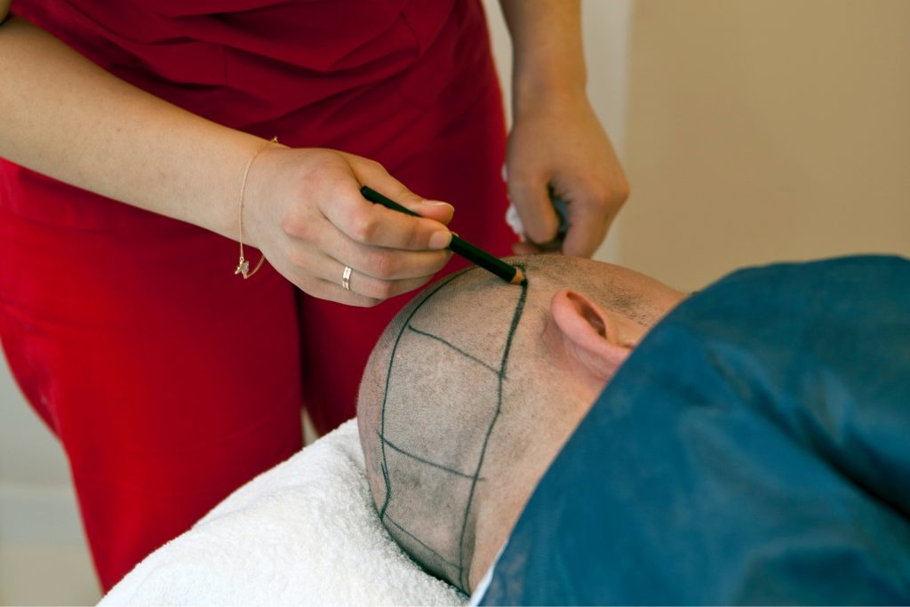 how much does a hair transplant cost in Turkey
